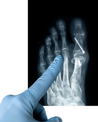 Finger in blue gloves pointes X-ray of the front foot after Hallux Valgus surgery