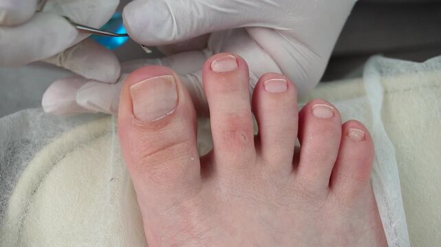 Podologist uses a curette to remove a callus on the toe