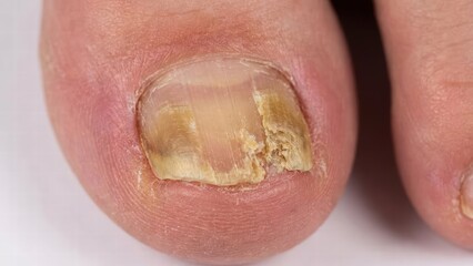 Fototapeta premium Nail health concerns close-up of fungal infection on toenail home setting medical image clinical focus