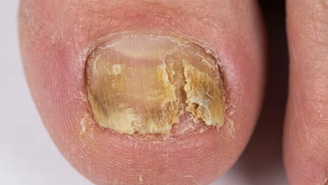 Nail infection treatment awareness medical setting health guide clinical environment close-up view preventative care tips for healthy nails