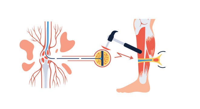 Detailed scientific illustration showing the neural pathway of the knee-jerk reflex, from the tendon stimulus to the spinal cord and muscle response.