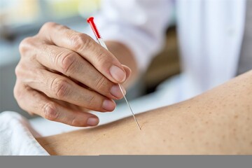 hand inject acupuncture needle on skin. Alternative medicine treatment