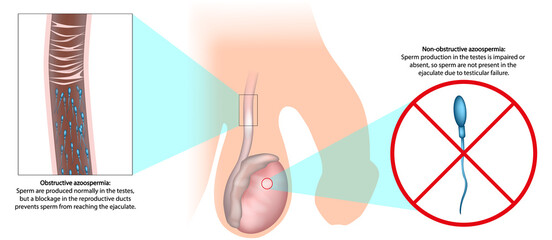Obstructive and Nonobstructive Azoospermia Medical Illustration Comparison. Male Infertility Diagram. Azoospermia Types. Male Reproductive System Illustration