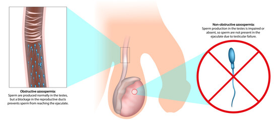 Obstructive and Nonobstructive Azoospermia Medical Illustration Comparison. Male Infertility Diagram. Azoospermia Types. Male Reproductive System Illustration