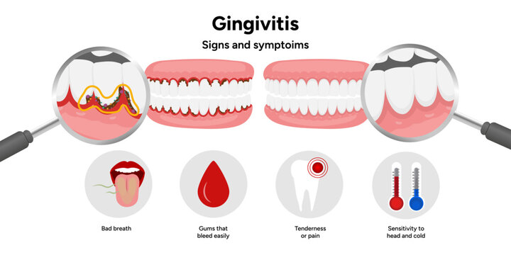 Hand-drawn dental illustration teeth with gingivitis with signs and symptoms. Educational medical infographic highlighting gum redness, swelling, bleeding gums, and plaque buildup