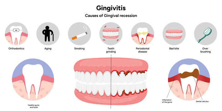 Hand-drawn dental infographic showing gingivitis and causes of gingival recession. Educational illustration explaining gum inflammation, receding gums, and periodontal problems