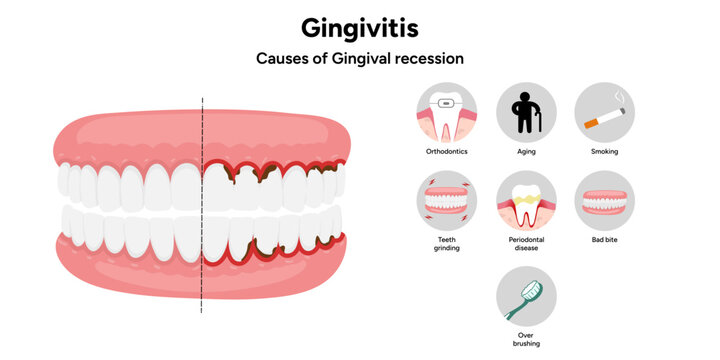 Hand-drawn dental infographic showing gingivitis and causes of gingival recession. Educational illustration explaining gum inflammation, receding gums, and periodontal problems