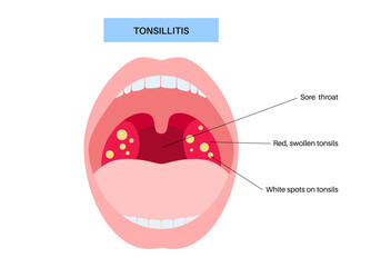 Obraz premium Tonsillitis medical poster