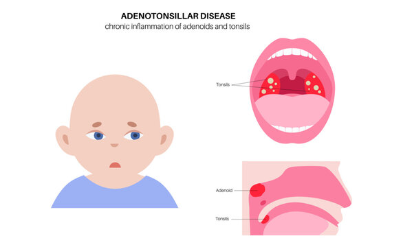 Adenotonsillar disease poster