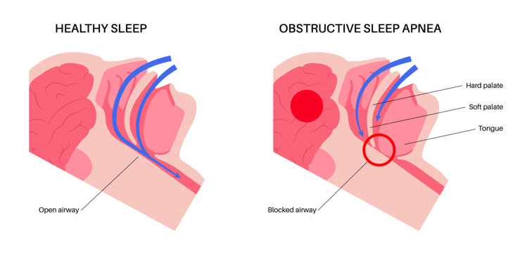 Obstructive sleep apnea