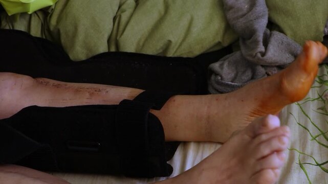 Home rehabilitation of an elderly woman after a tibia fracture with plates installed, leg exercise with an elastic band on a bed