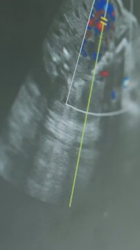 color Doppler ultrasound showing blood flow with red and blue mapping on screen, spectral Doppler peaks and velocity tracings visible while sonographer and cardiologist review hemodynamic patterns,
