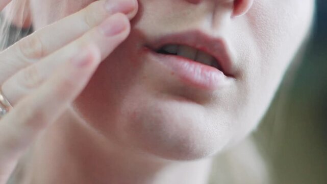 Close-up of a young woman examining her herpes on her lip with her hand. Redness and virus on the lips