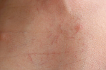 Close-up Image of Skin with Visible Stretch Marks and Textures