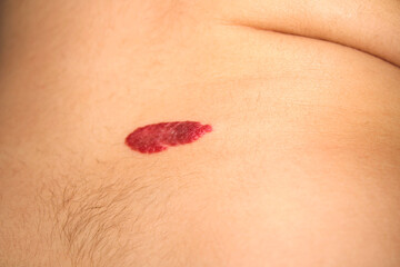 Close-Up of Skin with Red Mark or Lesion on Human Body Surface