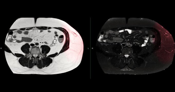 MRI whole abdomen video showing a fatty mass on the left side of the abdomen. Findings suggest a probable atypical lipomatous tumor, with differential diagnosis of well-differentiated liposarcoma. 