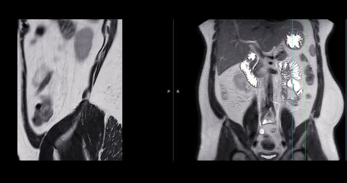 MRI whole abdomen video showing a fatty mass on the left side of the abdomen. Findings suggest a probable atypical lipomatous tumor, with differential diagnosis of well-differentiated liposarcoma. 
