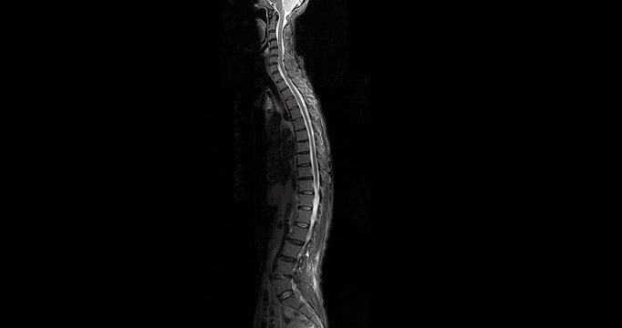 MRI screening of the whole spine in sagittal view for evaluating spinal cord stenosis. Clear visualization of vertebrae, discs, and spinal canal supports accurate diagnosis. 