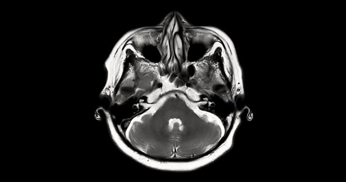 MRI brain footage showing normal anatomy with no abnormal findings. Clear visualization of brain structures highlights healthy neurological status. Ideal for medical education.