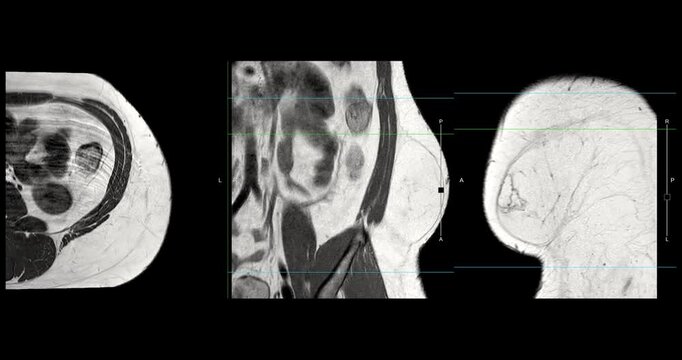 MRI whole abdomen footage showing a fatty mass on the left side of the abdomen. Findings suggest a probable atypical lipomatous tumor, with differential diagnosis of well-differentiated liposarcoma. 