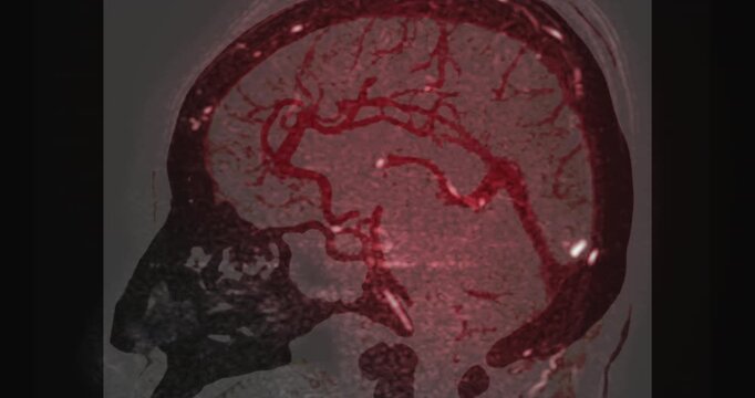 MR cerebral venography (MRV) or MRV Brain for diagnostic Cerebral venous thrombosis (blood clots in the brain) and 
Structural vein abnormalities.