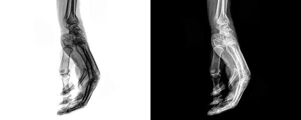 Wrist Lateral View X-Ray Radiograph Showing Bone Alignment and Joint Structure for Diagnosis of Fractures, Dislocations, Isolated on Transparent Background