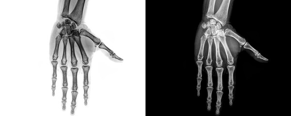 Hand Anterior Projection X-Ray Image Displaying Metacarpal and Phalangeal Bones for Detection and Evaluation of Fractures Isolated on Transparent Background