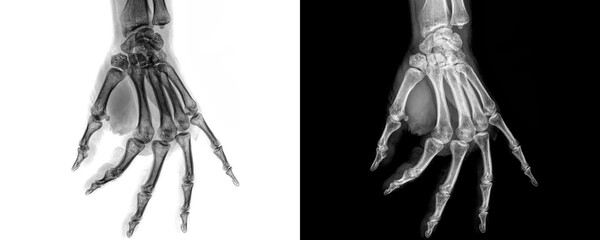 Hand Lateral Projection X-Ray Image Displaying Phalangeal and Metacarpal Bone Structure for Detection and Evaluation of Fractures Isolated on Transparent Background