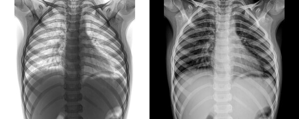 Chest Anterior View X-Ray Radiograph Showing Lung Fields, Heart Shadow, and Rib Structure for Accurate Diagnosis of Chest Pain Isolated on Transparent Background