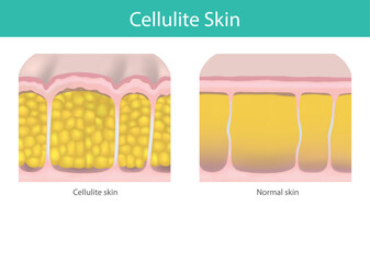 Comparison of Cellulite Skin vs Normal Skin.