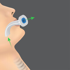 Placement of a Disposable Oral Airway