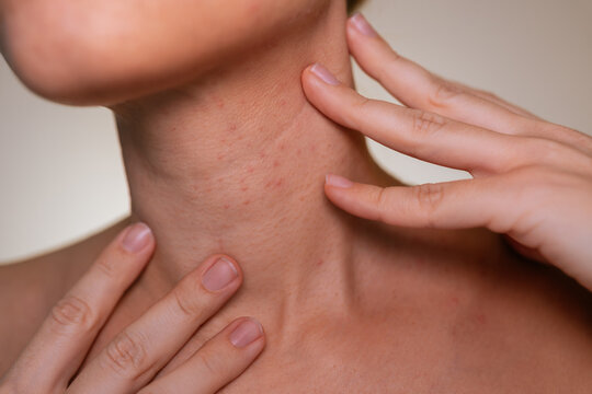 Young woman demonstrates the skin on her neck with acne and irritation. Natural skin texture, dermatology and skincare concept, beauty imperfection, sensitive skin, real body detail, cosmetic care
