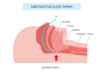 Obstructive sleep apnea © pikovit