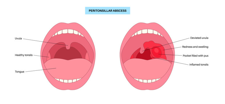 Peritonsillar abscess poster
