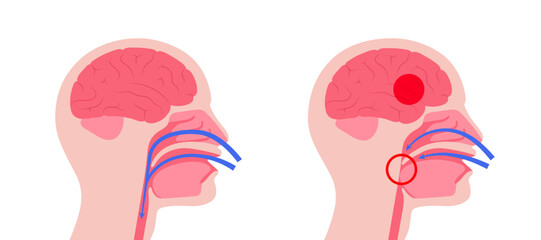 Obstructive sleep apnea