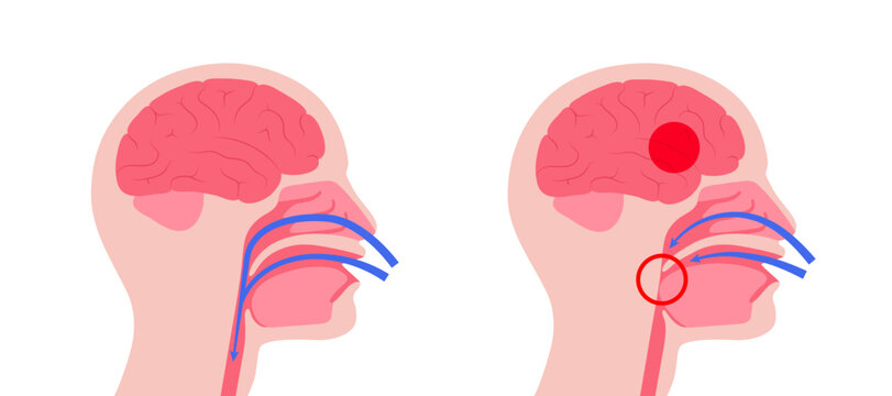 Obstructive sleep apnea