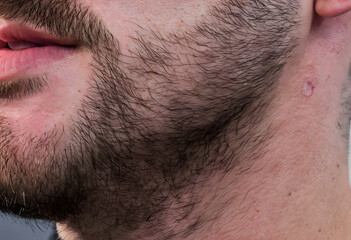 Fototapeta premium Man's face with beard and skin blemish