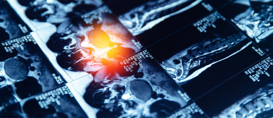 Mri scan of spinal column highlighting disc protrusion and vertebral structure banner, pinched...