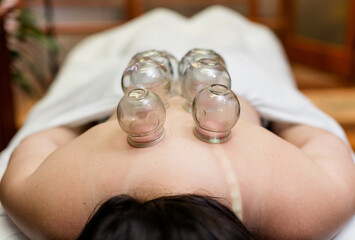 Patient Receiving Cupping on Back in San Diego