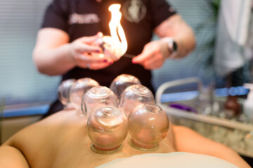 Acupuncturist Performing Cupping on Patient in San Diego