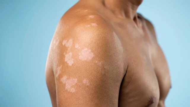 Close-up of a persons shoulder showing vitiligo skin condition.