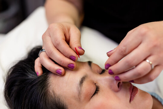 Close Up of Acupuncturist Inserting Needle in San Diego