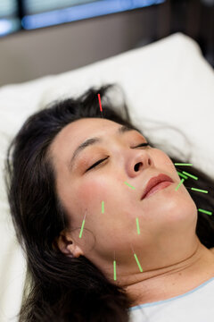 Patient Receiving Cosmetic Acupuncture in San Diego