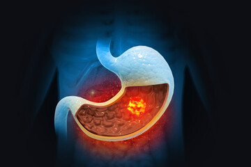 Stomach cancer. Cancer attacking cell. Stomach disease concept. 3d illustration