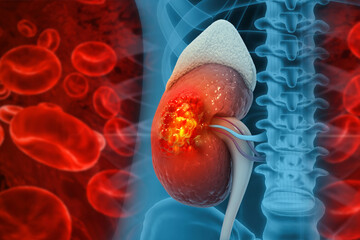 Medically accurate illustration of kidney cancer. showing presence of cancerous tumor inside the kidney. 3d illustration
