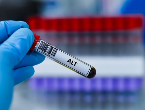Blood sample tube for alanine transaminase (ALT) test analysis.