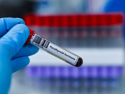 Blood sample tube for parathyroid hormone (PTH) test analysis.
