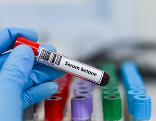 Blood sample tube for serum ketone test analysis.