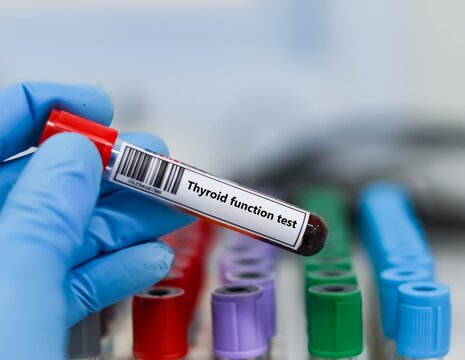 Blood sample tube for thyroid function test analysis.
