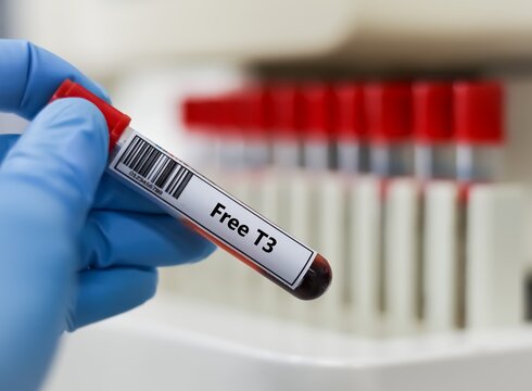 Blood sample tube for free T3 test analysis.